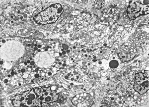 M,58y. | retroperitoneal liposarcoma